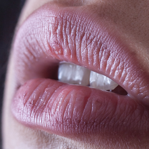 Korstjes na PMU Lip behandeling - Melissa Beauty Utrecht