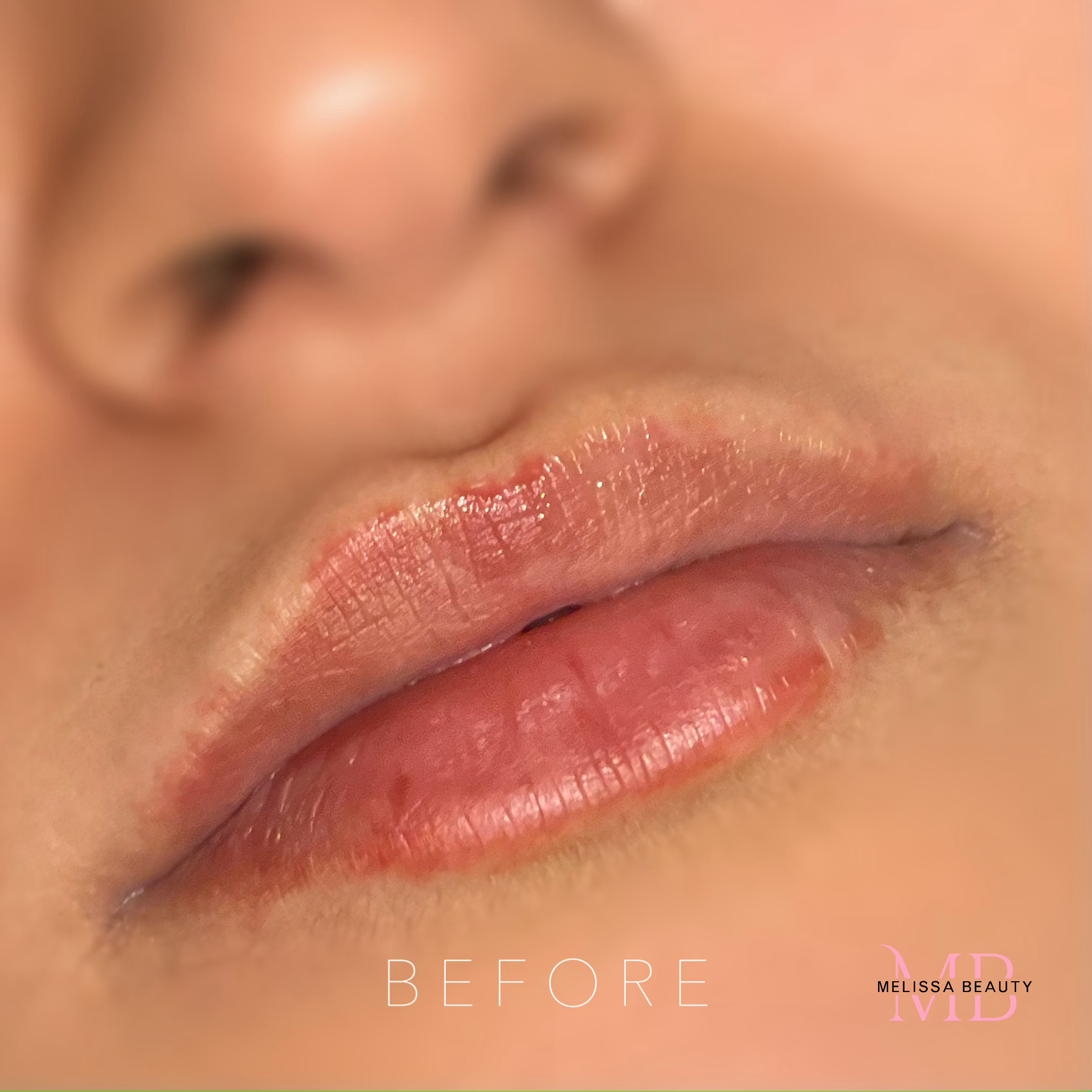 PMU Lip – Burcu – Before PMU Lip - Burcu - Before